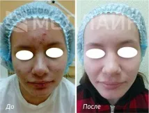 Медлайн - Лікування вугрової хвороби вугрової