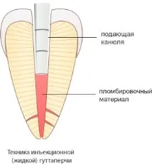 Методи пломбування кореневих каналів пломбування