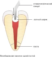 Методи пломбування кореневих каналів кореневих