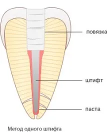 Методи пломбування кореневих каналів кореневих