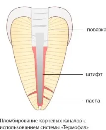 Методи пломбування кореневих каналів кореневих