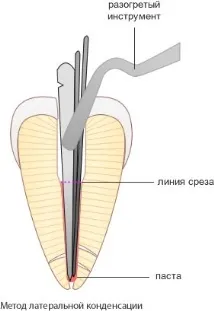 Методи пломбування кореневих каналів методи