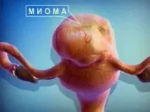 Чи можна засмагати при міомі матки або ендометріозі міомі