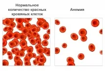 Рясна менструація – причини, лікування, рекомендації лікаря рясна