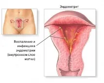 Рясна менструація – причини, лікування, рекомендації лікаря рясна