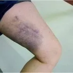 рехабилитация мускули