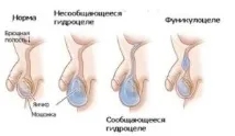 Пахвинна грижа у чоловіків наслідки після операції! чоловіків