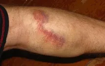 Переломи проксимального (верхнього) відділу гомілки верхнього