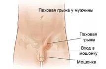 Пахвинна грижа у чоловіків наслідки після операції! чоловіків