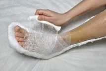 перелом