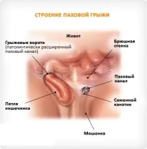 Пахвинна грижа у чоловіків наслідки після операції! після