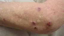 симптоми възрастни