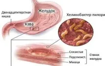 helicobacter акнето