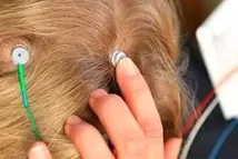 Застосування методу транскраніальної мікрополяризації у хворих на розсіяний склероз, Компетентно про застосування
