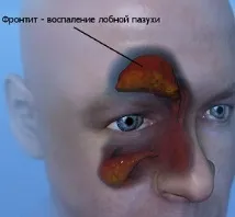 Профілактика фронтиту можна