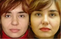 Ринопластика - ціни, фото до та після після