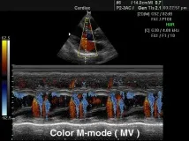 Режим сканування M-mode - звичайний, кольоровий та анатомічний режим