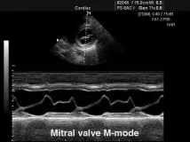 Режим сканування M-mode - звичайний, кольоровий та анатомічний m-mode