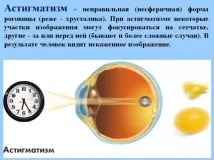 комплексен миопичен