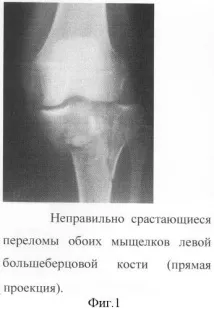 метод костна