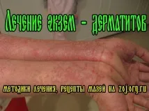 Суха екзема на руках суха