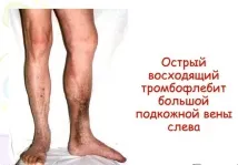 Тромбофлебіт нижніх кінцівок, глибоких вен, види, симптоми, лікування варикозу види