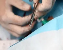 Видалення швів після операції після