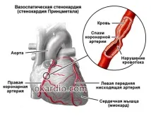 вазоспастична ангина