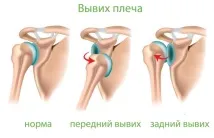 лечение рамото