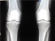 Вроджене порушення у розвитку колінного суглоба особливості та лікування дисплазії у дітей та дорослих порушення