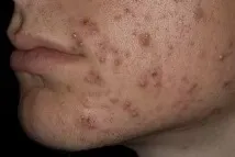 причини акне