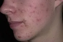 акне вулгарис Иванов Лвов