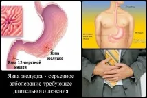 Виразка шлунка симптоми та прояв - докладна інформація шлунка