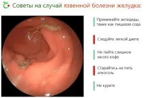 Виразка шлунка симптоми та прояв - докладна інформація шлунка