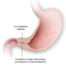 Виразка шлунка симптоми та прояв - докладна інформація симптоми