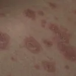 Заразний рожевий лишай чи ні для людини рожевий