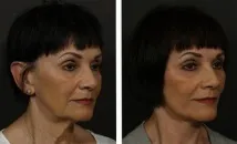 златни лифтинг