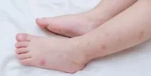 симптоми дървеници