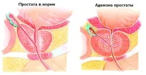 аденом заболяването