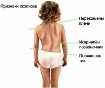 Хвороби хребта класифікація, симптоми та лікування Хвороби