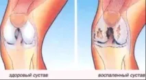 Деформуючий артроз коліна - лікування 1, 2, 3 ступеня, Лікування суглобів деформуючий