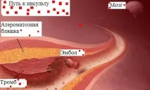 Що таке тромб тромбозу