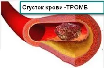 Що таке тромб таке