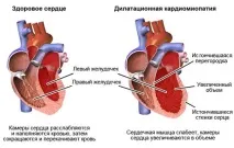 Дилатаційна кардіоміопатія - що це таке, лікування, симптоми, прогноз кардіоміопатія