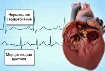 Дилатаційна кардіоміопатія - що це таке, лікування, симптоми, прогноз прогноз