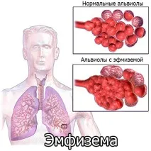 Емфізема легенів причини та смптоми причини