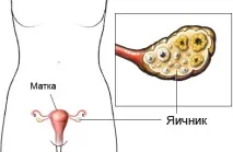 Функціональна кіста яєчника – Огляд теми, Медичний портал EUROLAB кіста