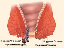 Геморой симптоми, лікування в домашніх умовах та ефективні засоби від геморою домашніх