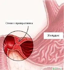 Гіпертрофія пілоруса – Ветеринарна клініка доктора Шустової, Ветеринар Балаково ветеринарна