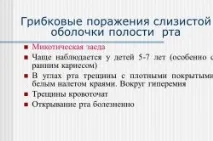 Грибок у роті симптоми та лікування грибок